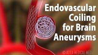 Endovascular Coiling for Brain Aneurysm Animation [upl. by Aenea392]