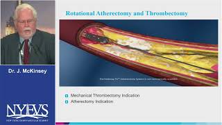 Debulking for ISR Choice of Device McKinsey Session II Superficial femoral artery PART II [upl. by Kaleena]