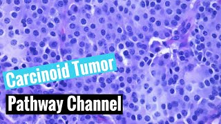 Typical carcinoid tumor of the lung neuroendocrine tumors [upl. by Marcell]