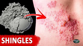 How to Get Rid of Shingles  Shingles Treatment at Home [upl. by Aivart]