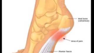 How to Use Dorsal Night Splints for Plantar Fasciitis [upl. by Ihtraa9]