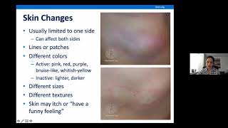 Localized Scleroderma Overview [upl. by Skippie]