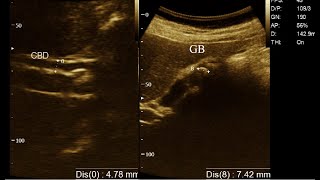 Calculus Cholecystitis  Biliary tree is mild dilated  Amader hospital  Ultrasonography report [upl. by Decamp]