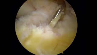 Modified Anatomical Anterior Cruciate Ligament Reconstruction with Flat Semitendinosus Graft [upl. by Aerdnahs850]