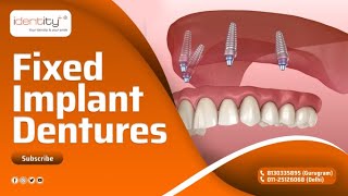 Fixed Implant Denture  Dr Sharad Gupta [upl. by Epuladaug]