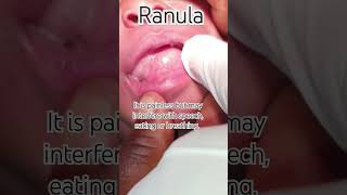 Lingual Bubble ranula oralpathology education salivarycyst health dentistryknowledge tongue [upl. by Nonnaer240]