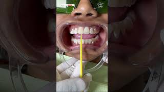 Best Dental Crown  Zirconia  Best Dentist in Kolkata  zirconiacrown smilemakeover smiledesign [upl. by Lacombe]