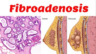 4 Fibrocytic Disease  Fibroadenosis [upl. by Lysander]