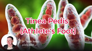 11 Tinea pedis Athletes foot [upl. by Elinet535]