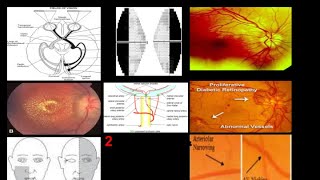 Optic Tract pupillary light reflex Ophthalmoscopy Papilledema PseudoPapilledema Retinopathies [upl. by Aedni]