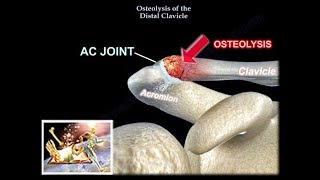 Distal Clavicle Osteolysis  Everything You Need To Know  Dr Nabil Ebraheim [upl. by Aekal]