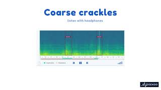 Lung sounds  coarse crackles [upl. by Nongim456]