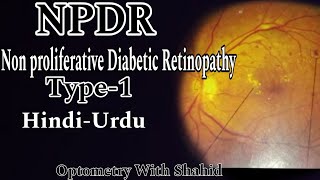 Non Proliferative Diabetic Retinopathy  Part1  Optometry With Shahid [upl. by Gaby165]