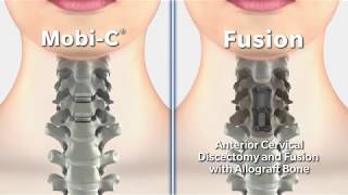 Cervical Disc Surgery  MobiC versus Fusion 2 [upl. by Asirap582]