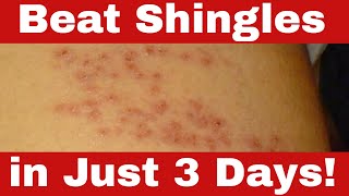 How to Cure Shingles in 3 Days  Simple Proven Home Remedies [upl. by Keheley]