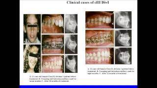 simultanious torquing and intrusion arch  orthodontic courses by Indian dental academy [upl. by Alliuqaj404]