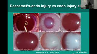 Steven E Wilson MD Update on the use of Topical losartan for corneal scarring 6 11 24 [upl. by Nimra277]