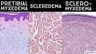 Pretibial Myxedema vs Scleredema vs Scleromyxedema  Dermatopathology quotSoundAlikesquot [upl. by Ij]