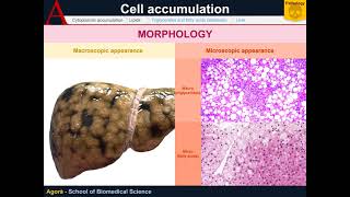 Cellular Pathology  Lipid accumulation [upl. by Mccully467]