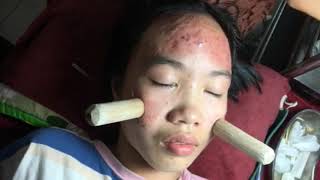 Introduction about inflammatory acne and how to solve it PART 1  official video  742019 [upl. by Justicz487]