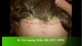 Dr Kin Leung Naturopathic Case Review Patient with Psoriasis Vulgaris plaque silver scales on scalp [upl. by Siroled]