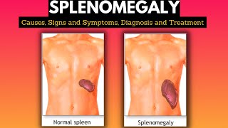 Splenomegaly Causes Signs and Symptoms Diagnosis and Treatment [upl. by Kurys963]