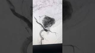 Extraaxial post fossa hemangioblastoma [upl. by Aelyk]