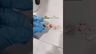 Blood typing blood grouping mls cls laboratory medtechstudent medicaltechnologist bloodbank m [upl. by Aerol]