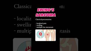 Clinical features of Ewing sarcoma ewing cancer bones orthopedics neetpg bonepain pediatrics [upl. by Philomena]