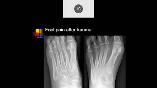 MRI of the Ankle Part 13 – Ankle Bone Injuries [upl. by Berna877]