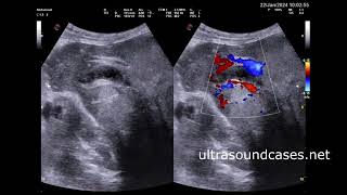 Изменения печени при эхинококкозе Changes in the liver during echinococcosis [upl. by Israel]