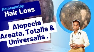 Alopecia Totalis amp Universalis Effective Homeopathic Treatment at Fidicus Homeopathy Dr Bharadwaz [upl. by Aip951]