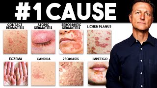 The MOST Common Deficiency in All Skin Diseases Dermatitis [upl. by Erelia428]