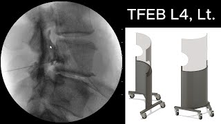 L4 Transforaminal Epidural Steroid Injection TFESI 정확하게 하는 방법 2 [upl. by Heiskell722]