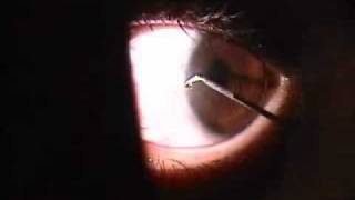 Corneal Foreign Body [upl. by Wivina]