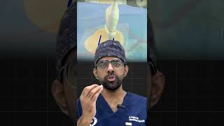 How is GAE Therapy done What is the procedure kneepain arthritis ytshorts doctor [upl. by Eeleimaj176]