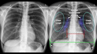 Introduction to Chest X ray  Anteroposterior view Lateral view Cardiothoracic ratio cardiomegaly [upl. by Aneeras]