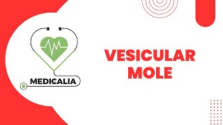 Vesicular mole  part 3    Treatment  Investigations [upl. by Settle]