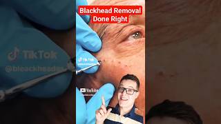 Crazy Satisfying BLACKHEAD REMOVAL  Perfect Extraction shorts [upl. by Yonit]