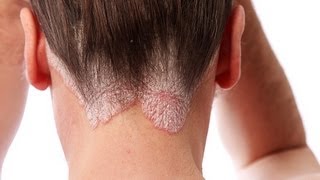 Scalp Psoriasis Shampoo  Do They Really Work [upl. by Arahd989]