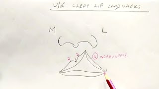 Cleft lip  part 1 [upl. by Jacy]