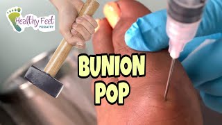 Ganglion Cyst Popped Out Of Bunion [upl. by Harty]