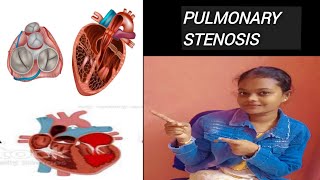 PULMONARY STENOSIS DEFINITION CAUSES PATHOPHYSIOLOGY DIAGNOSIS AND TREATMENT [upl. by Pallas164]