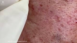 Big Cystic Acne Blackheads Extraction Blackheads amp Milia Whiteheads Removal Pimple Popping [upl. by Blessington606]