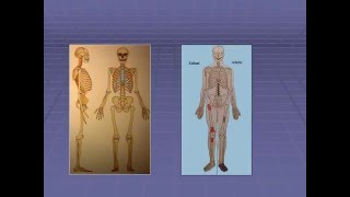 traumatologie L’OSTEOMYELITE AIGUE HEMATOGENE [upl. by Avonasac]