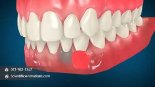 Gum Grafting Surgery  Dental Animation [upl. by Malamut]