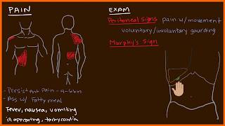 Acute Cholecystitis 23 [upl. by Seebeck]