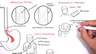 GORD GERD Gastro Oesophageal Reflux Disease  Overview pathophysiology treatment [upl. by Nosaes]