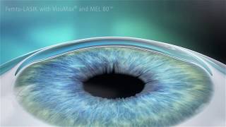 Visumax and MEL 80 Femto LASIK Animation [upl. by Boland]