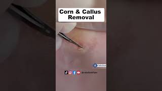 Corn amp Callus Removal [upl. by Nonnek89]